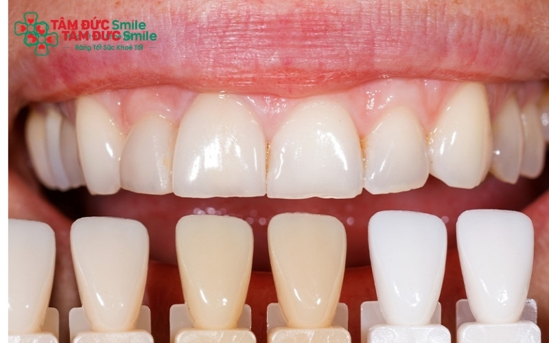 Ưu điểm lớn nhất của sứ bán phần là tính bảo tồn cao, hạn chế tối đa việc xâm lấn và mài nhỏ răng thật, từ đó giúp răng chắc khỏe lâu dài.