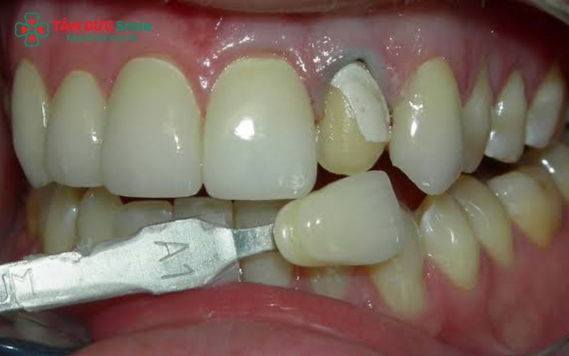 Răng sứ bị gãy để lộ cùi răng thật không chỉ gây ê buốt mà còn tạo điều kiện cho vi khuẩn xâm nhập, dẫn đến nguy cơ viêm tủy và mất răng nếu không xử lý kịp thời.