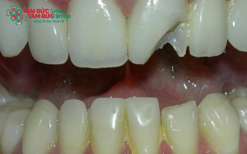 Thói quen ăn nhai thực phẩm quá cứng hoặc dùng răng bọc sứ để mở vật dụng là những nguyên nhân phổ biến nhất khiến mão sứ bị nứt vỡ, gãy hỏng