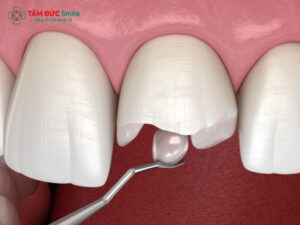 Bọc răng sứ bị gãy có nguy hiểm không? Nguyên nhân và cách khắc phục