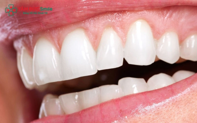Với các vết mẻ lớn hoặc miếng trám cũ đã xuống cấp, bọc răng sứ giúp bảo vệ cấu trúc răng thật bên trong và ngăn ngừa ê buốt kéo dài.