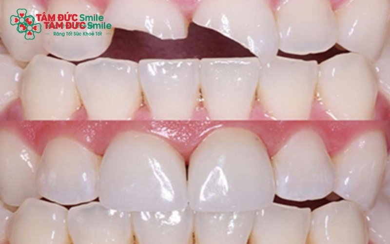 Các dòng răng toàn sứ hiện đại có độ bền cao và độ trong mờ tự nhiên, giúp răng cửa sau khi bọc sứ trông y hệt răng thật.
