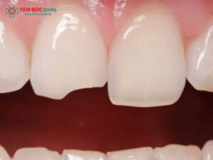 Bọc răng sứ cho răng cửa bị mẻ có nên không?