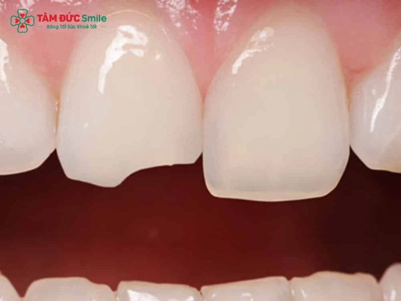 Bọc răng sứ cho răng cửa bị mẻ có nên không?