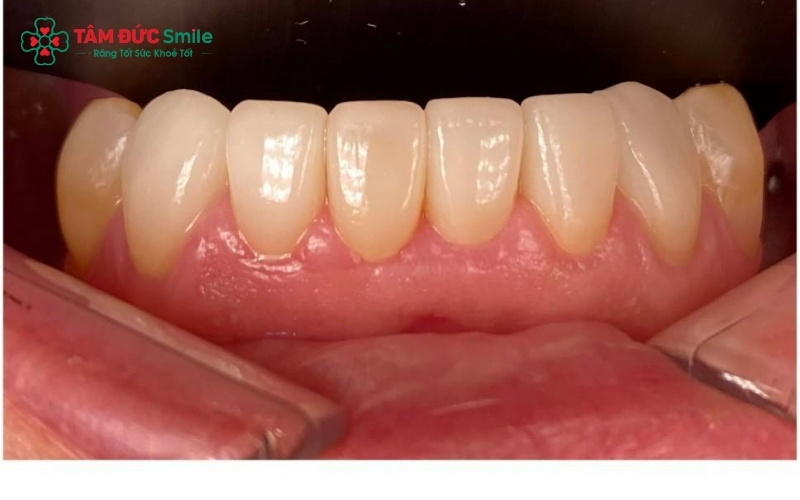 Răng sứ dính liền (cầu răng sứ) với các mão răng được kết nối chặt chẽ thành một khối thống nhất.