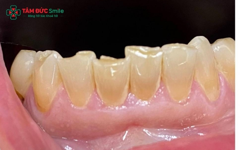 Bọc răng sứ dính liền giúp phục hồi chức năng ăn nhai và mang lại vẻ đẹp tự nhiên cho hàm răng ngay sau khi thực hiện