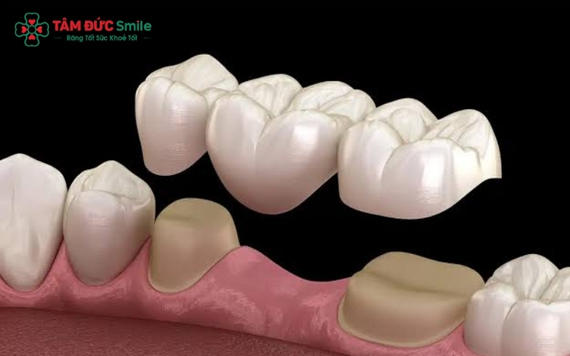 Sự khác biệt giữa răng sứ rời (vệ sinh dễ dàng hơn) và răng sứ dính liền (giải pháp tối ưu khi bị mất răng).