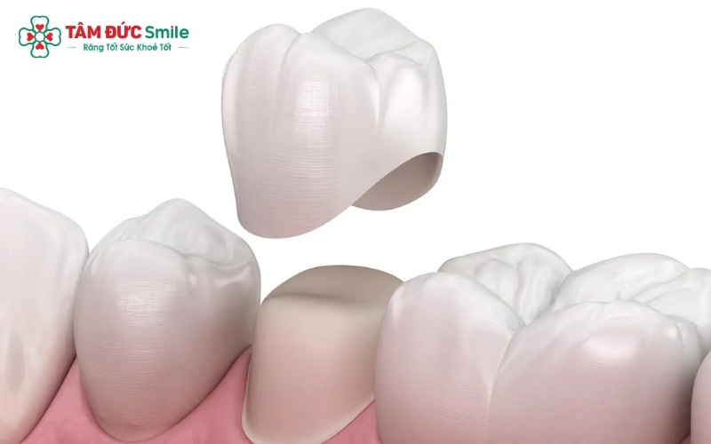 Bọc răng sứ dùng để phục hồi răng hư tổn, trong khi trồng răng sứ là giải pháp thay thế hoàn toàn cho răng đã bị mất.