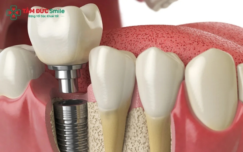 Tùy vào tình trạng còn chân răng hay mất răng mà bác sĩ sẽ chỉ định bọc sứ, làm cầu răng hay trồng răng Implant để đạt hiệu quả tốt nhất.