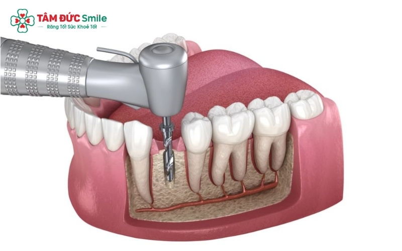 Chi phí phục hình phụ thuộc vào chất liệu sứ và kỹ thuật thực hiện