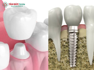 Bọc răng sứ và trồng răng sứ khác nhau thế nào? Nên chọn phương pháp nào?
