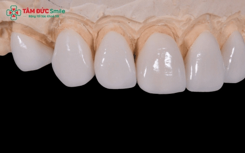 Răng toàn sứ (phải) có độ thấu quang và tính thẩm mỹ cao vượt trội so với răng sứ kim loại, là lựa chọn tối ưu khi bọc số lượng nhiều.