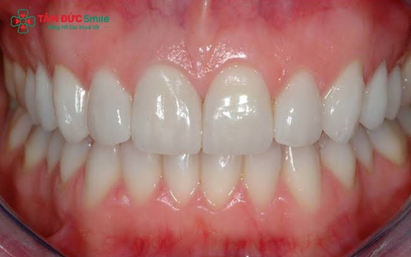 Các khuyết điểm phổ biến về hình thể và màu sắc răng có thể khắc phục hoàn hảo bằng phương pháp bọc sứ thẩm mỹ