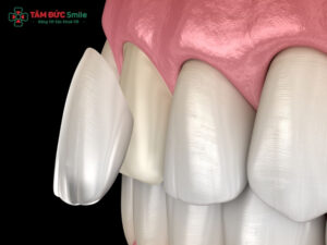 Bọc sứ răng cửa bị lệch có được không? Lưu ý sau khi bọc sứ răng cửa bị lệch