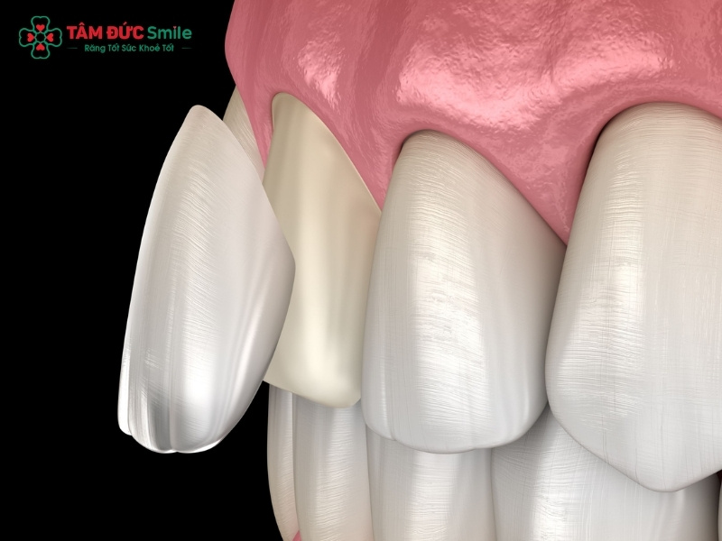 Bọc sứ răng cửa bị lệch có được không? Lưu ý sau khi bọc sứ răng cửa bị lệch