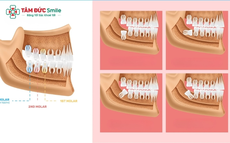 Tổng hợp các tư thế mọc phổ biến của răng khôn: Từ mọc thẳng đến các tư thế lệch 45 độ, mọc ngang hoặc mọc ngầm dưới nướu.