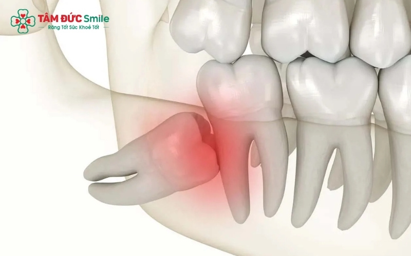 Răng khôn mọc thẳng và răng khôn mọc lệch gây chèn ép, tổn thương nghiêm trọng đến cấu trúc răng số 7 bên cạnh.