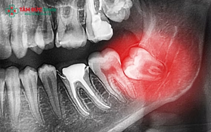 Biểu hiện viêm lợi trùm và sưng tấy vùng nướu trong cùng – một trong những dấu hiệu điển hình cảnh báo răng khôn cần được xử lý.