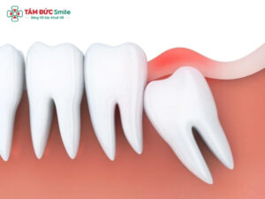Các loại răng khôn thường gặp và cách xử lý an toàn