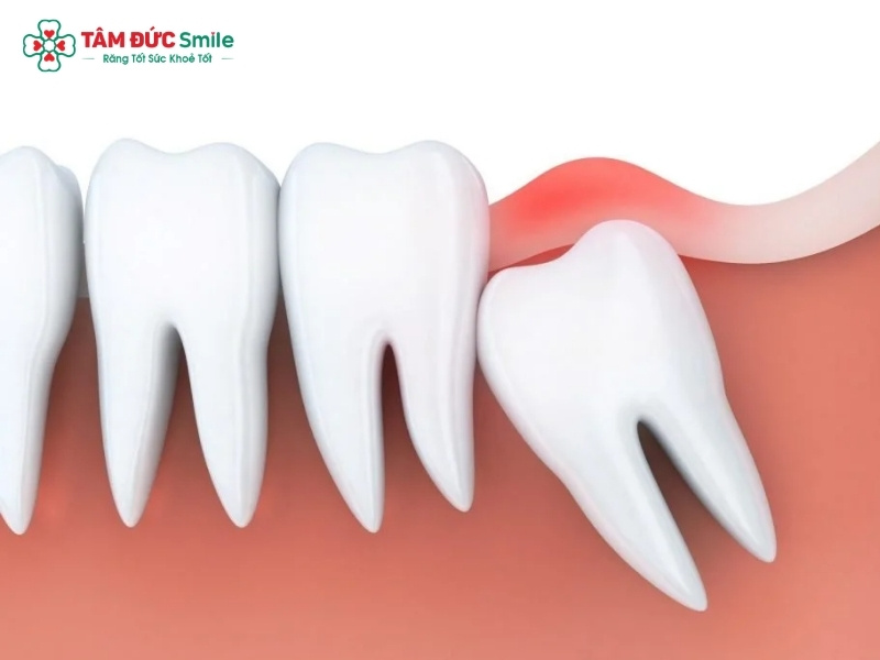 Các loại răng khôn thường gặp và cách xử lý an toàn