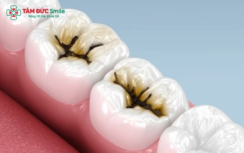 Các chấm đen hoặc lỗ hổng trên bề mặt răng hàm là những dấu hiệu nhận biết sớm của bệnh sâu răng.