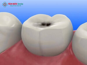Cách chữa sâu răng hàm: Trám, chữa tủy hay nhổ răng?