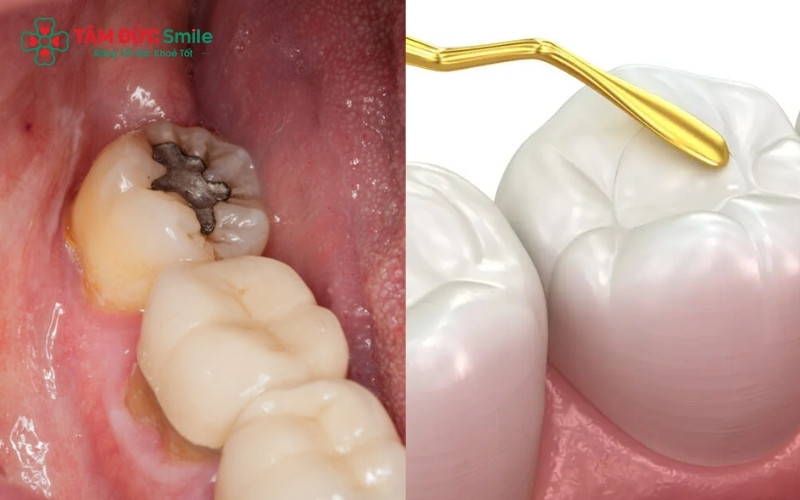 Tùy vào mức độ hư tổn, bác sĩ sẽ chỉ định trám răng hoặc điều trị tủy để bảo tồn tối đa răng hàm thật.