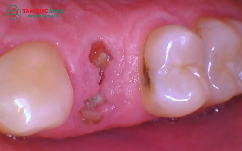 Không phải chân răng sâu nào cũng cần nhổ bỏ; bác sĩ sẽ ưu tiên bảo tồn nếu chân răng còn vững chắc và đủ điều kiện để làm chốt phục hồi.