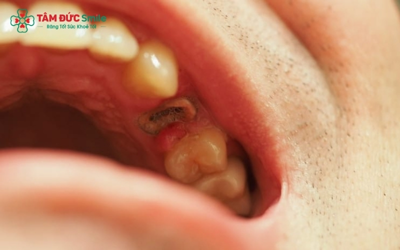 Với công nghệ gây tê hiện đại và máy siêu âm Piezosurgery, việc lấy chân răng sâu diễn ra rất nhẹ nhàng, không gây đau đớn hay tổn thương nướu.
