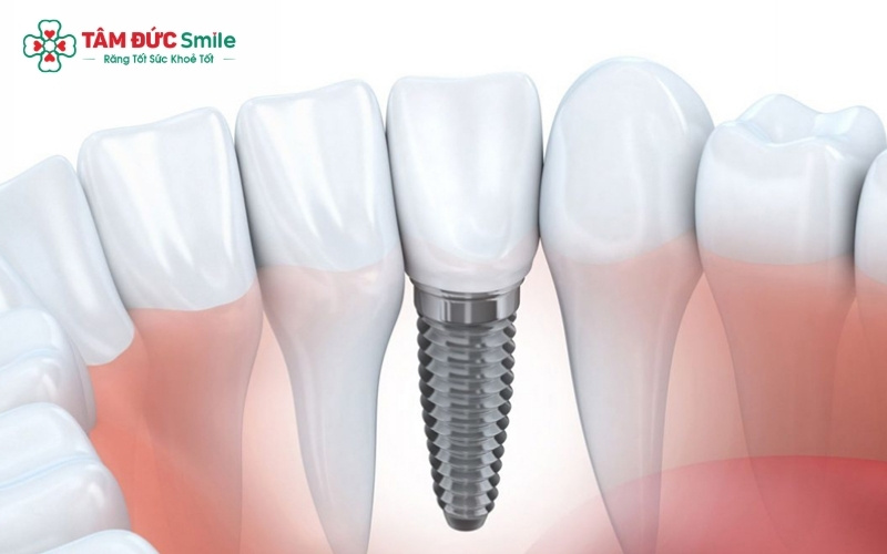 Sau khi nhổ chân răng sâu, cần thực hiện trồng lại răng sớm để tránh tình trạng các răng lân cận bị xô lệch và tiêu xương hàm làm biến dạng khuôn mặt.