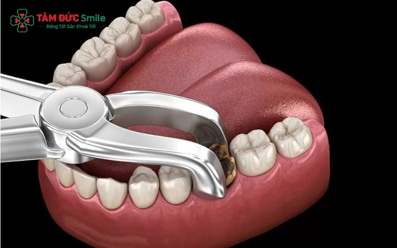 Chân răng sâu thường bám chặt trong xương hàm; việc tự ý nhổ tại nhà có thể gây nhiễm trùng máu, đứt dây thần kinh hoặc sót chân răng.