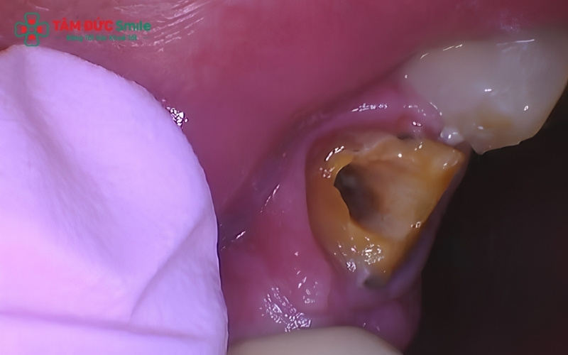 Khi vùng nướu quanh chân răng bị sưng tấy hoặc có mủ, bạn cần đến nha khoa ngay lập tức để tránh biến chứng lan rộng sang các răng khác.