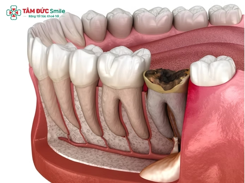 Cách nhổ răng sâu chỉ còn chân răng tại nhà có an toàn không?