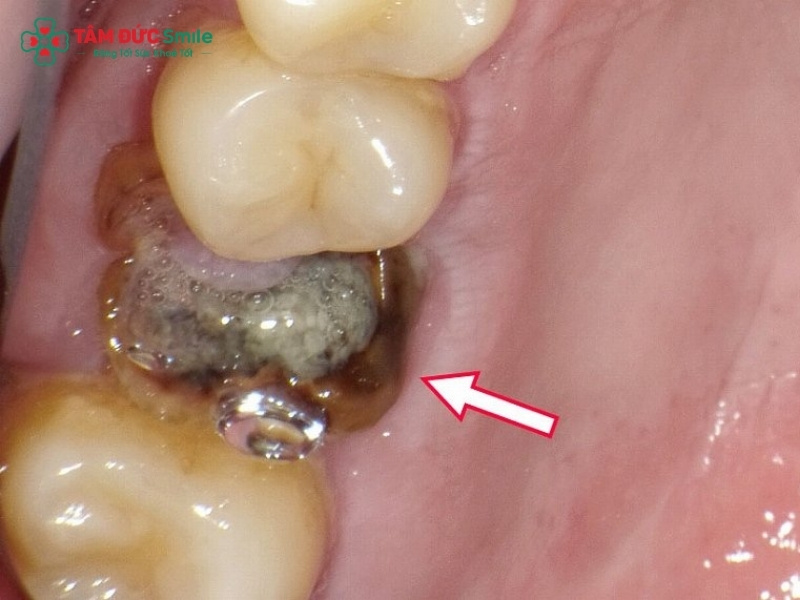 Cách nhổ răng sâu chỉ còn chân răng an toàn tại Nha khoa