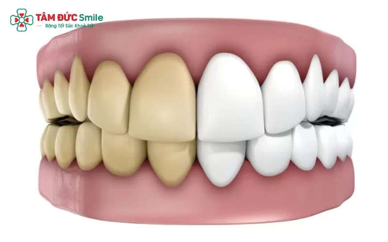 Hầu hết các trường hợp răng ố vàng do thực phẩm hoặc tuổi tác đều có thể cải thiện độ sáng rõ rệt nhờ các phương pháp tẩy trắng hiện đại.