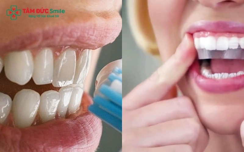 Sử dụng miếng dán hoặc máng tẩy trắng tại nhà là giải pháp tiện lợi giúp duy trì độ sáng của răng một cách chủ động.