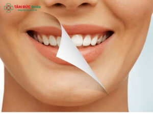 Cách tẩy trắng răng ố vàng an toàn, hiệu quả tại nhà