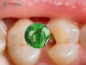 Cách trị sâu răng bằng lá lốt có hiệu quả không? Các cách giảm đau tạm thời bằng lá lốt