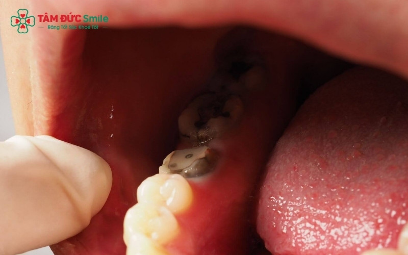 Không nên lạm dụng lá lốt khi răng đã có dấu hiệu sưng mủ hoặc đau lan lên thái dương, vì đây là lúc tình trạng nhiễm trùng đã tiến triển nặng.