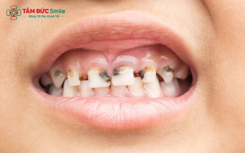 Ba mẹ nên thường xuyên kiểm tra răng của bé; những chấm đen nhỏ trên mặt nhai là dấu hiệu sớm của tình trạng sâu răng sữa ở trẻ.