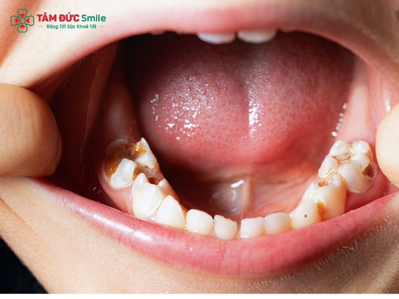 Cách trị sâu răng cho bé an toàn, hiệu quả