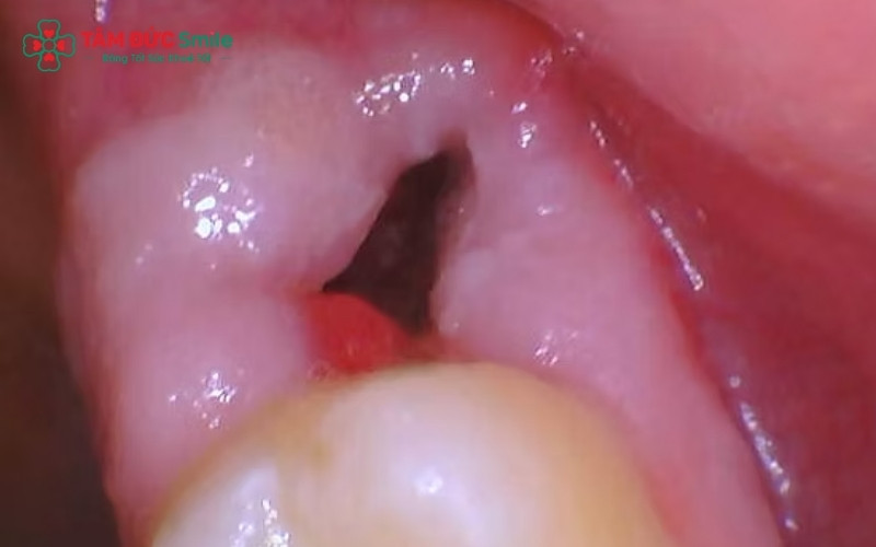 Đau dữ dội kéo dài hoặc sưng lan rộng là những dấu hiệu bất thường bạn cần quay lại nha khoa để bác sĩ kiểm tra kịp thời.