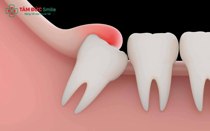 Độ khó của ca tiểu phẫu phụ thuộc rất lớn vào vị trí mọc của răng khôn, quyết định mức độ can thiệp và cảm giác của bạn sau đó.