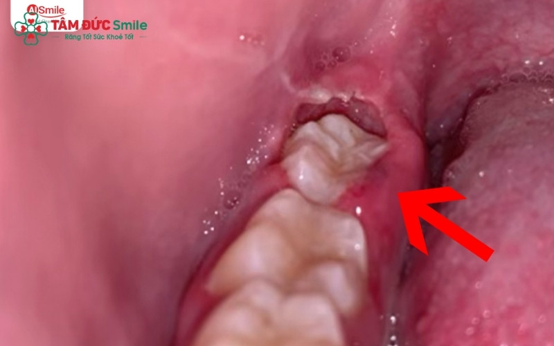 Lợi trùm tạo thành một khe hở khiến thức ăn dễ mắc kẹt, gây viêm nhiễm và đau nhức vùng răng trong cùng.