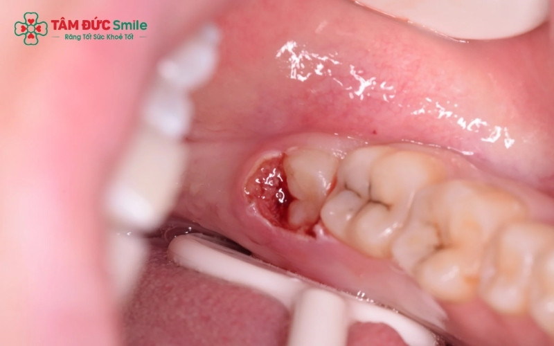 Sử dụng công nghệ Laser trong cắt lợi trùm giúp cầm máu tức thì, hạn chế sưng đau và đẩy nhanh tốc độ lành thương.