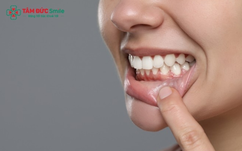 Cầu răng sứ bị hở thường lộ rõ khoảng trống ở chân răng, khiến thức ăn dễ mắc lại và gây cảm giác răng bị lỏng lẻo khi ăn nhai.