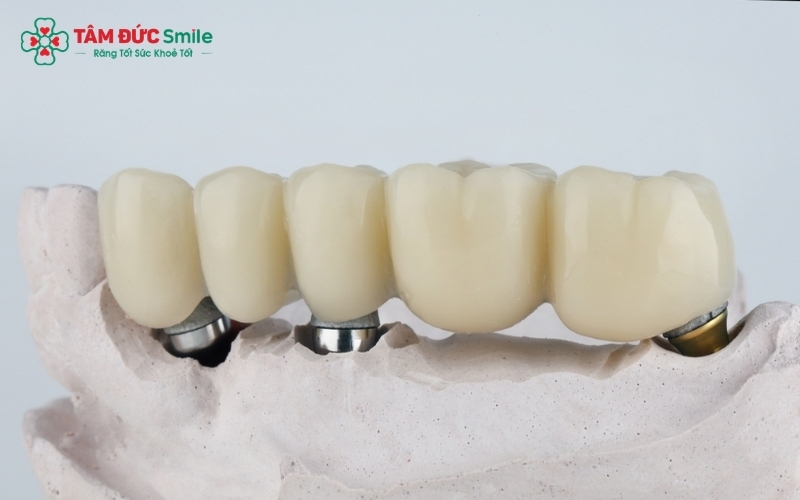 Khi cầu răng bị hở, bác sĩ sẽ tháo bỏ cầu cũ để vệ sinh răng trụ và chỉ định làm lại cầu mới hoặc cấy ghép Implant để bảo tồn xương hàm.
