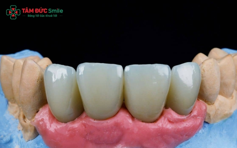 Cầu răng sứ răng cửa có nên làm không? Lưu ý khi làm cầu răng sứ răng cửa