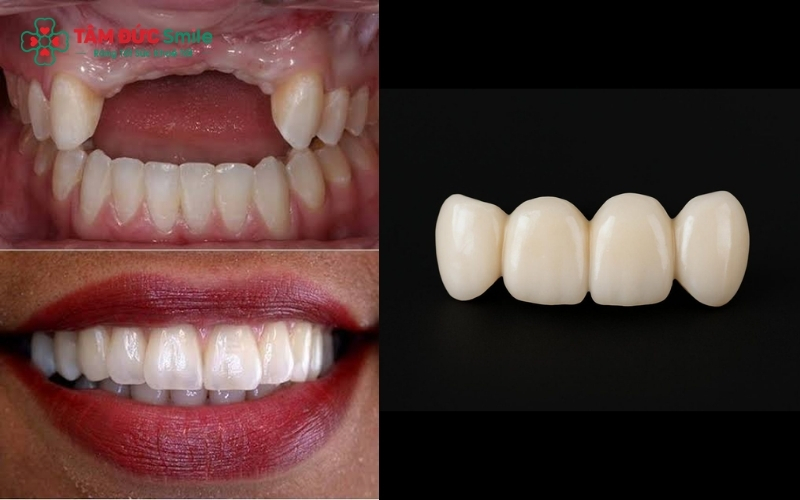 Việc có nên làm cầu răng sứ hay không phụ thuộc vào tình trạng răng trụ có đủ chắc khỏe để nâng đỡ dải cầu và đảm bảo chức năng ăn nhai hay không