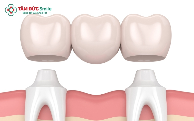 Ưu điểm lớn nhất của cầu răng sứ răng cửa là khôi phục nụ cười tự nhiên một cách nhanh chóng